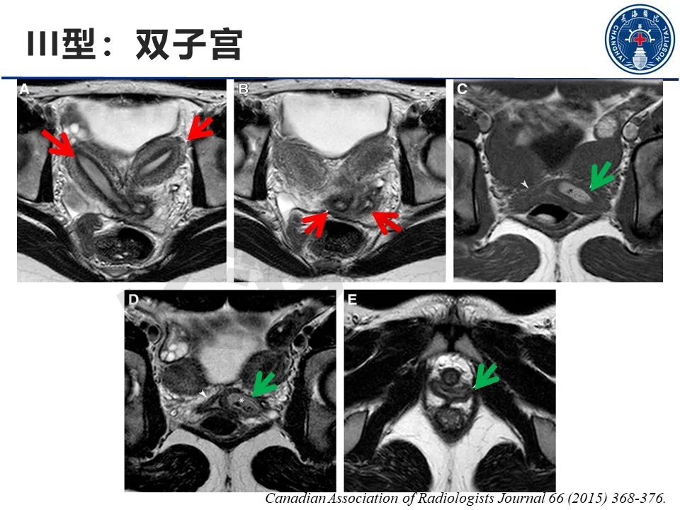 【PPT】子宫畸形的分类及MR诊断-14