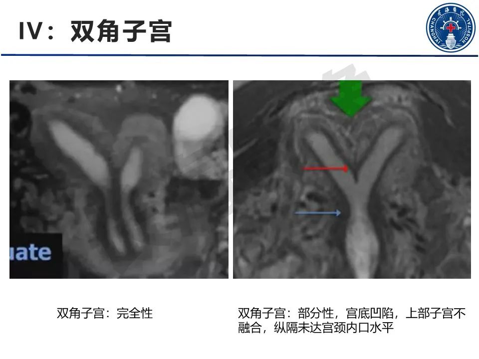 【PPT】子宫畸形的分类及MR诊断-16