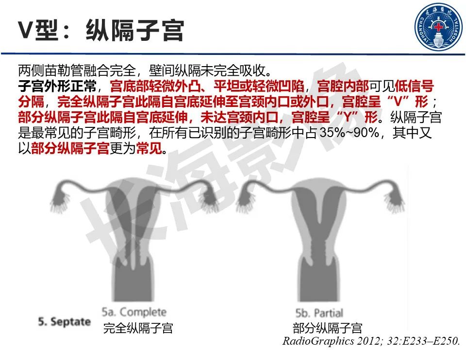 【PPT】子宫畸形的分类及MR诊断-17