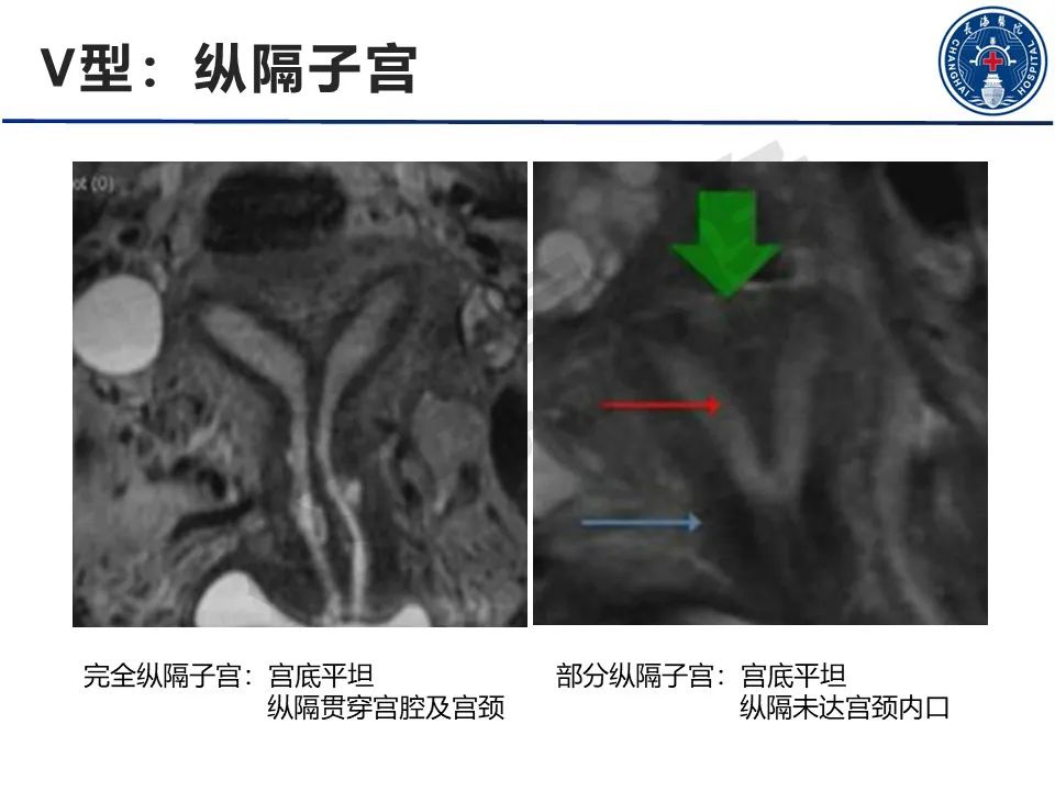 【PPT】子宫畸形的分类及MR诊断-18
