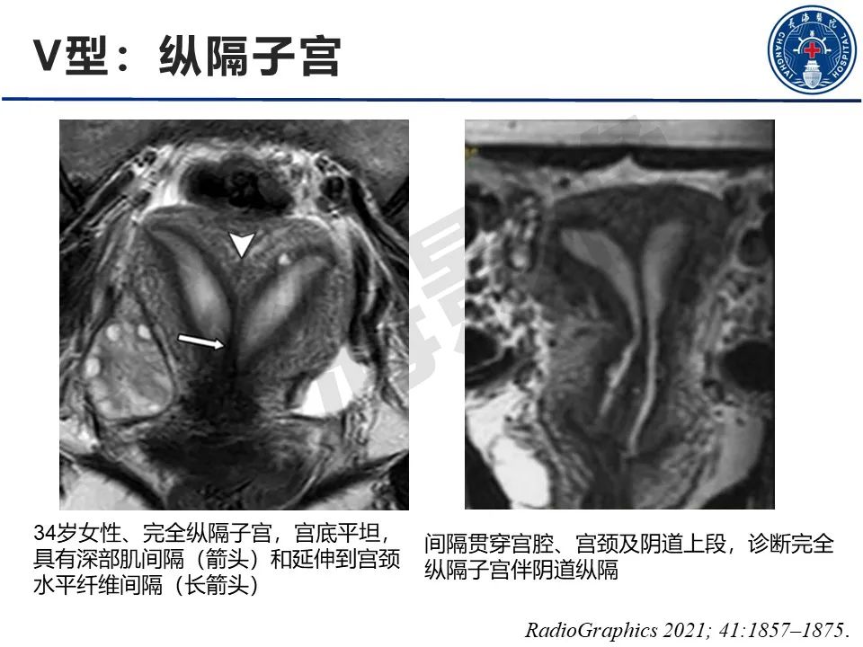 【PPT】子宫畸形的分类及MR诊断-19