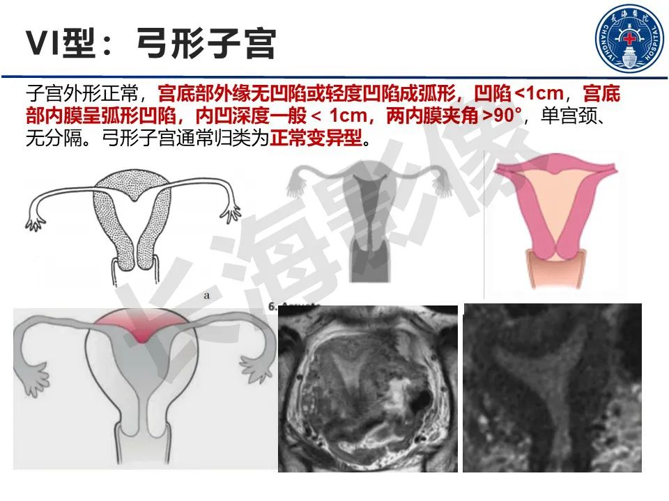 【PPT】子宫畸形的分类及MR诊断-20