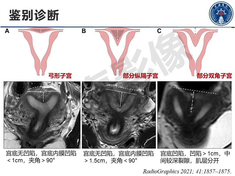 【PPT】子宫畸形的分类及MR诊断-22