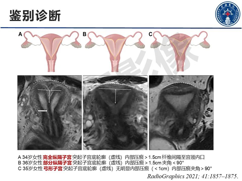 【PPT】子宫畸形的分类及MR诊断-23