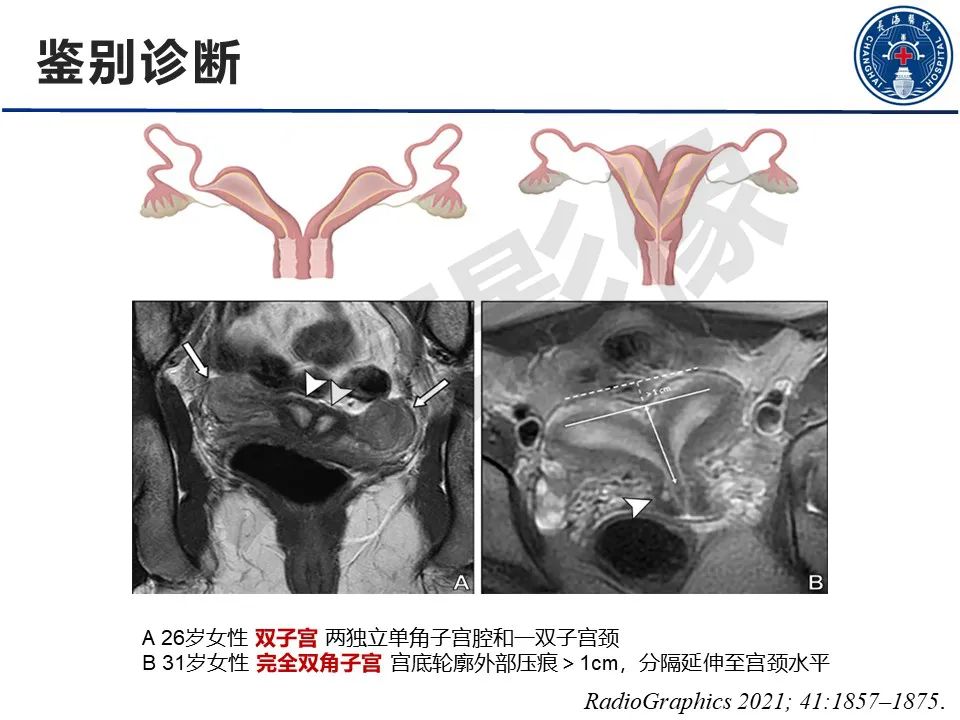 【PPT】子宫畸形的分类及MR诊断-24