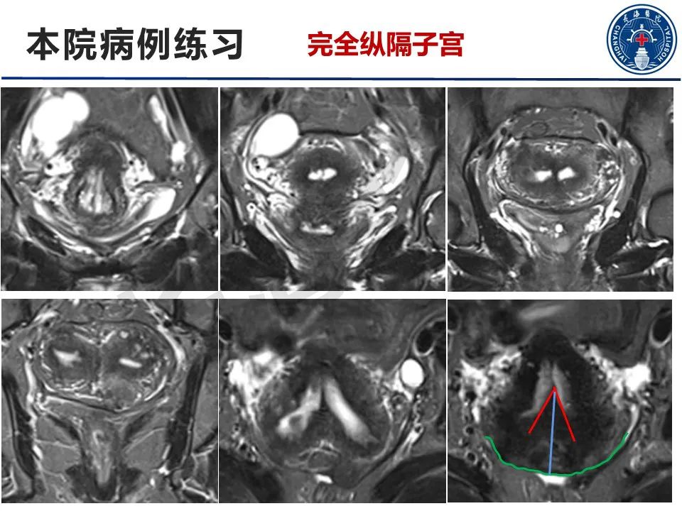 【PPT】子宫畸形的分类及MR诊断-29