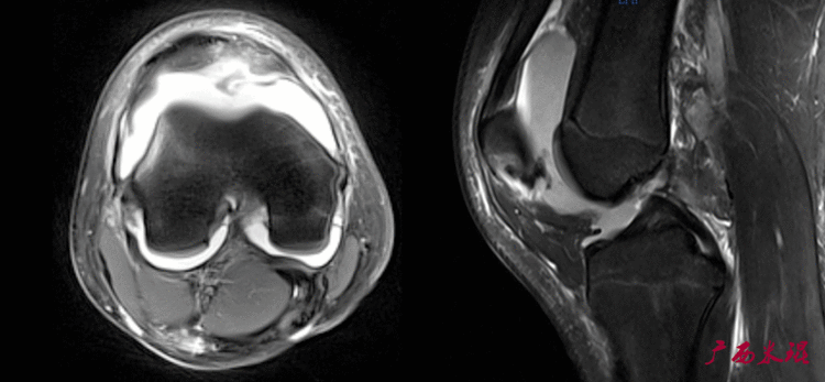 半月板损伤的MRI诊断基础