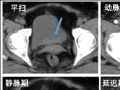 腺性膀胱炎