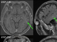 肺癌患者，增强MRI脑实质出现强化结节就一定是转移瘤吗？