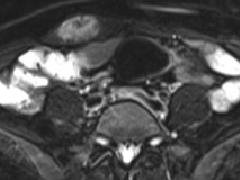 腹壁韧带样纤维瘤1例MR影像