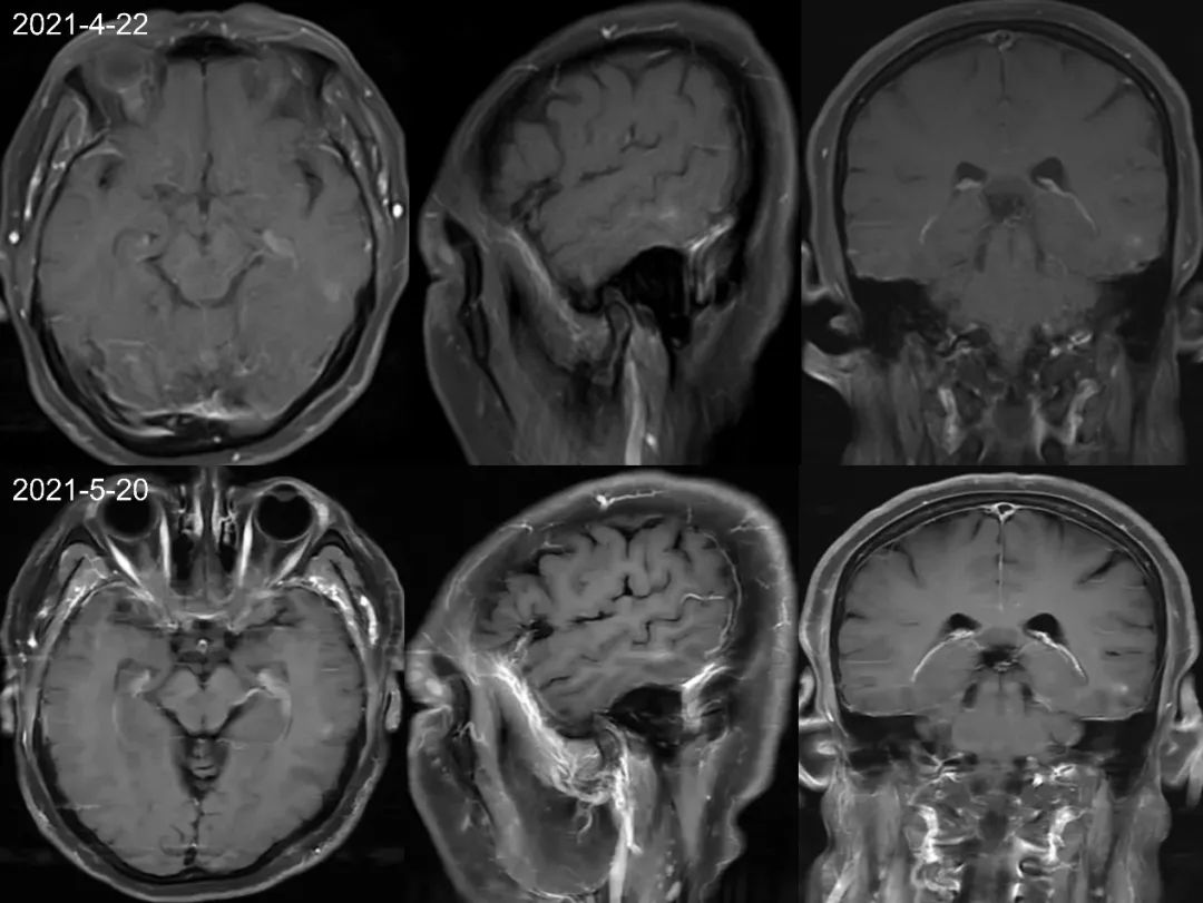 【病例】肺癌患者，增强MRI脑实质出现强化结节就一定是转移瘤吗？-2