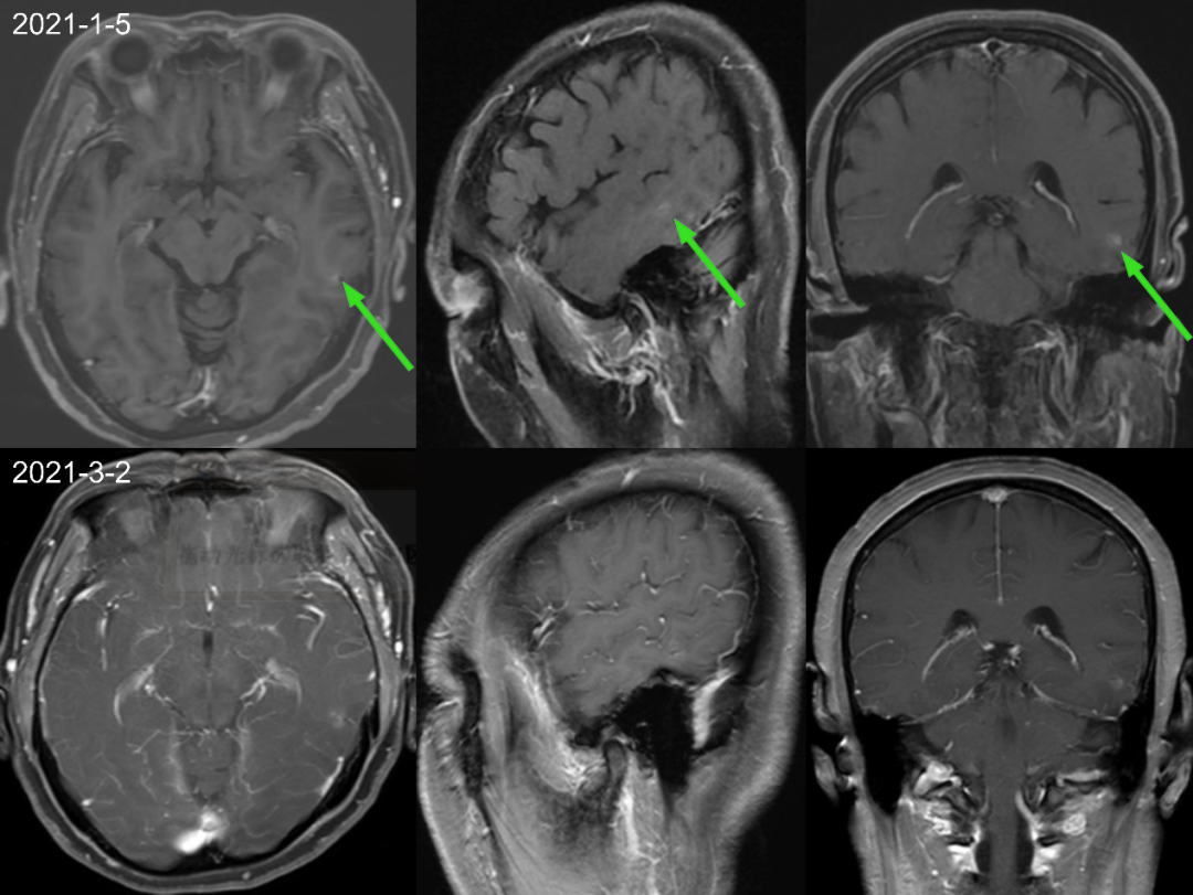 【病例】肺癌患者，增强MRI脑实质出现强化结节就一定是转移瘤吗？-1