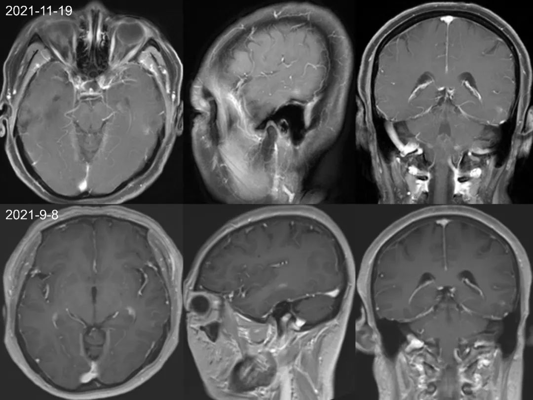 【病例】肺癌患者，增强MRI脑实质出现强化结节就一定是转移瘤吗？-3