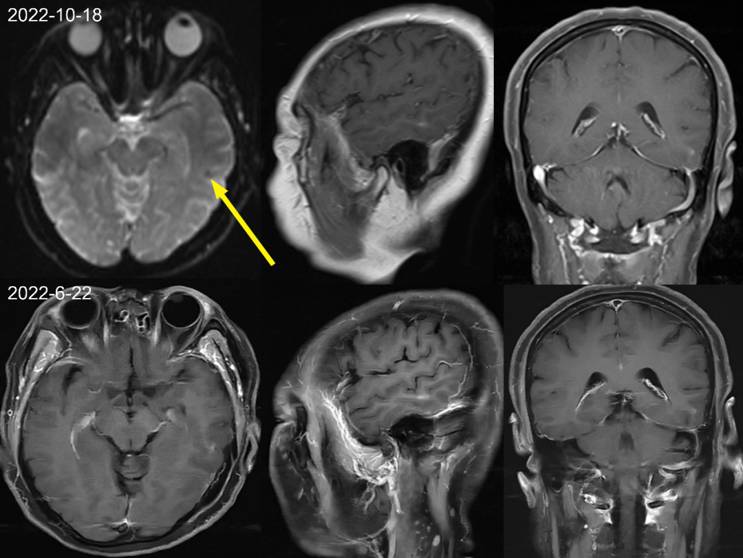 【病例】肺癌患者，增强MRI脑实质出现强化结节就一定是转移瘤吗？-4