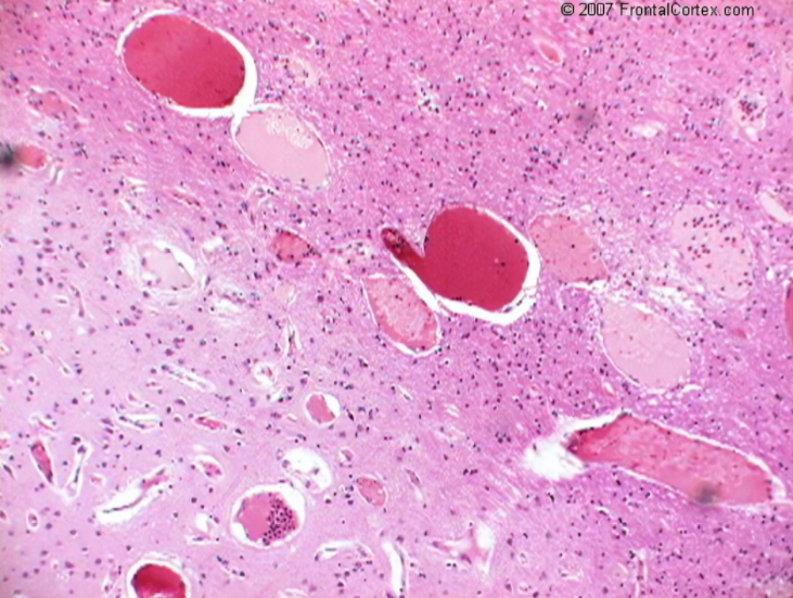 【病例】肺癌患者，增强MRI脑实质出现强化结节就一定是转移瘤吗？-5