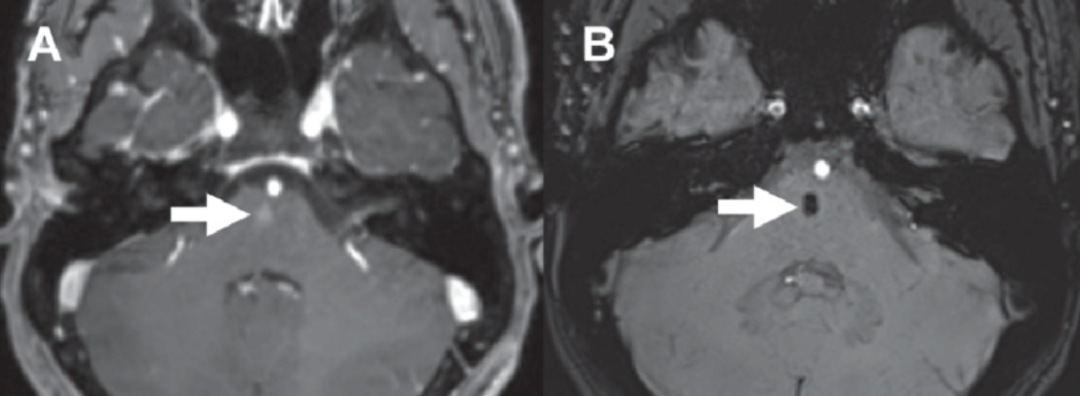 【病例】肺癌患者，增强MRI脑实质出现强化结节就一定是转移瘤吗？-7