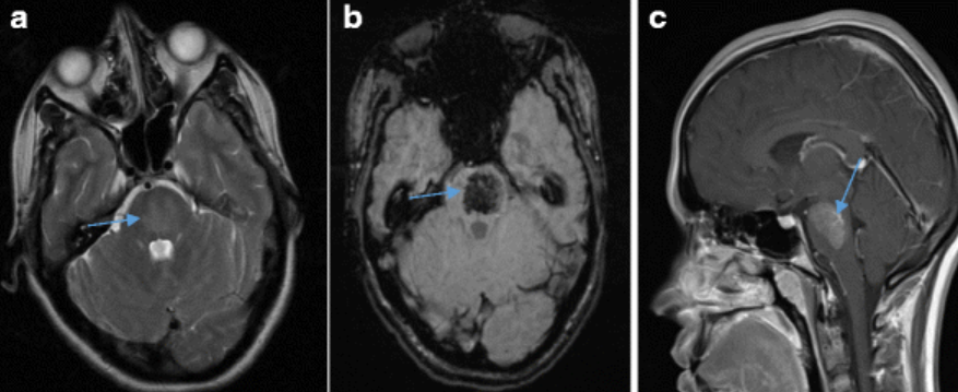 【病例】肺癌患者，增强MRI脑实质出现强化结节就一定是转移瘤吗？-8
