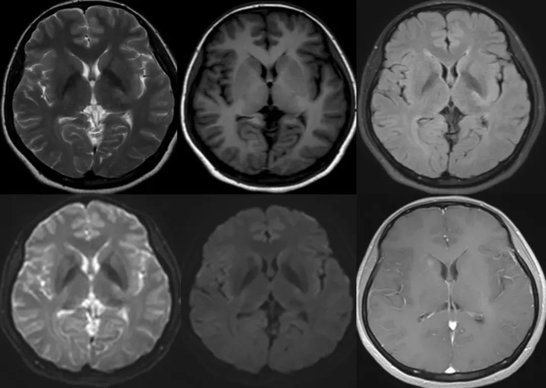 【病例】肺癌患者，增强MRI脑实质出现强化结节就一定是转移瘤吗？-9