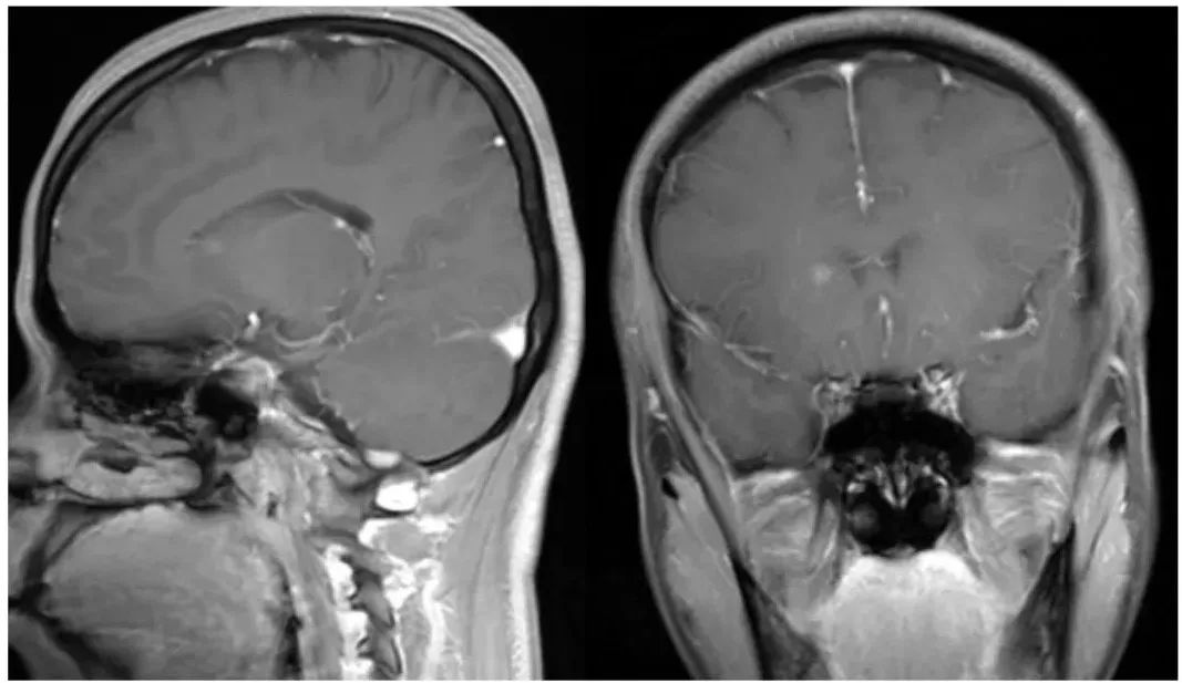 【病例】肺癌患者，增强MRI脑实质出现强化结节就一定是转移瘤吗？-10