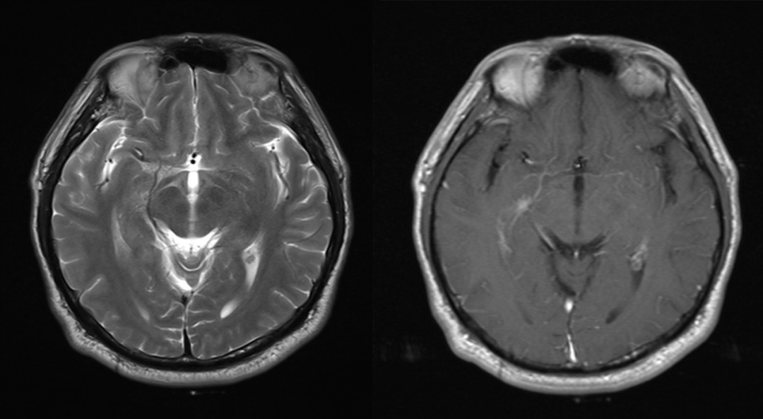 【病例】肺癌患者，增强MRI脑实质出现强化结节就一定是转移瘤吗？-11