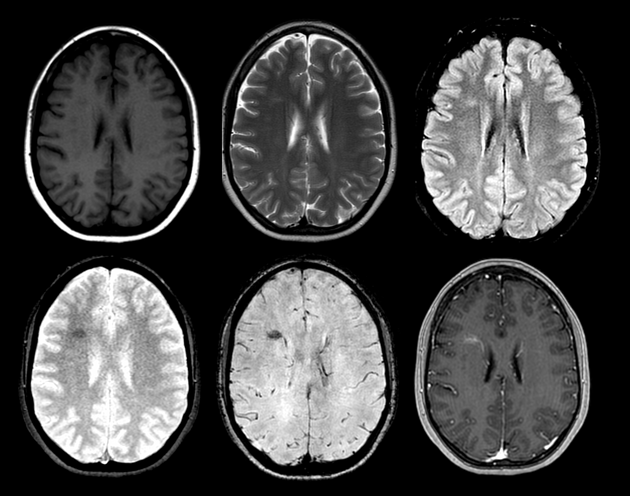 【病例】肺癌患者，增强MRI脑实质出现强化结节就一定是转移瘤吗？-12