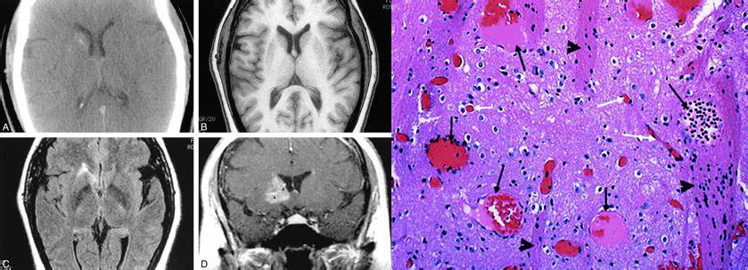 【病例】肺癌患者，增强MRI脑实质出现强化结节就一定是转移瘤吗？-13