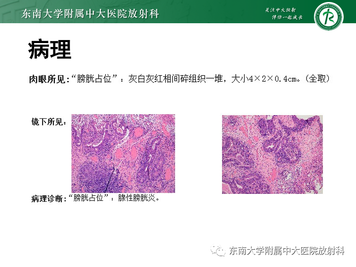 【PPT】腺性膀胱炎-4