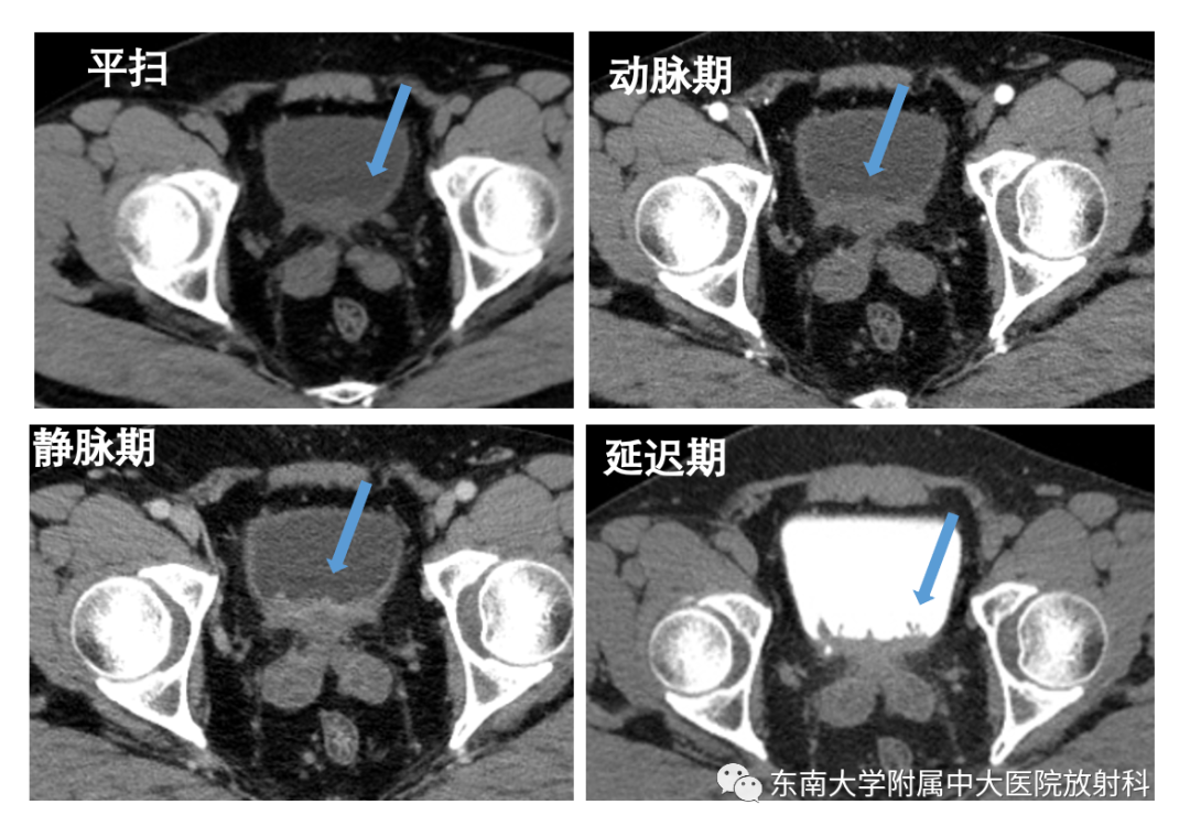 【PPT】腺性膀胱炎-3