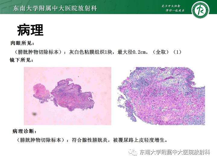 【PPT】腺性膀胱炎-2