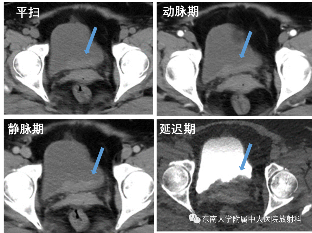 【PPT】腺性膀胱炎-1