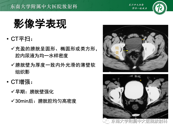 【PPT】腺性膀胱炎-9