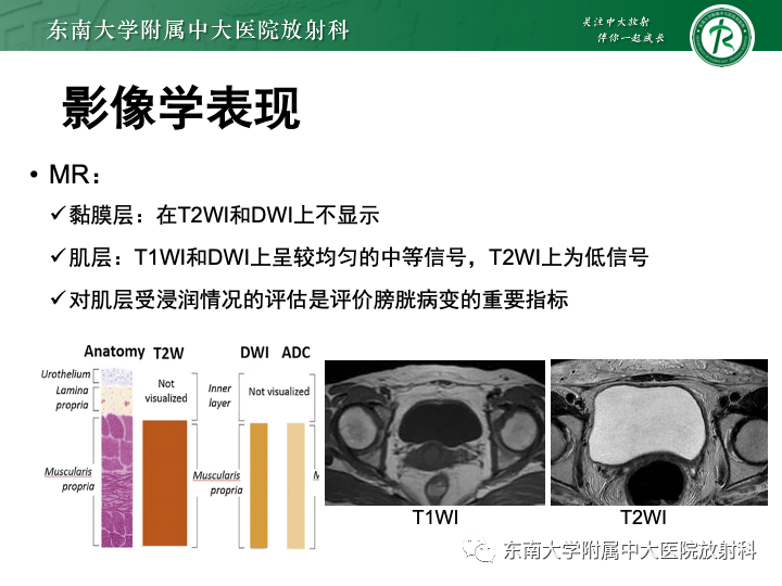 【PPT】腺性膀胱炎-10