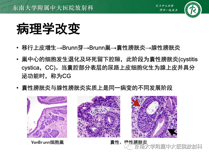 【PPT】腺性膀胱炎-12
