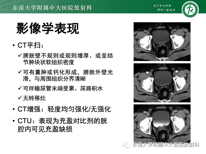 【PPT】腺性膀胱炎-16