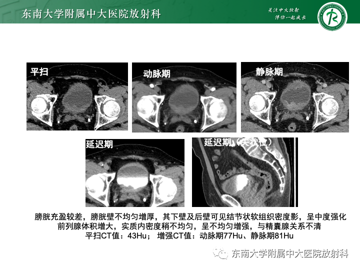 【PPT】腺性膀胱炎-24