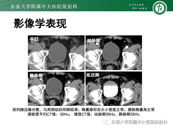 【PPT】腺性膀胱炎-28