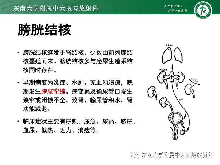 【PPT】腺性膀胱炎-29