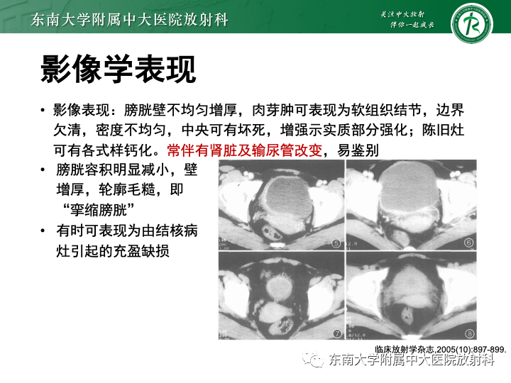 【PPT】腺性膀胱炎-30