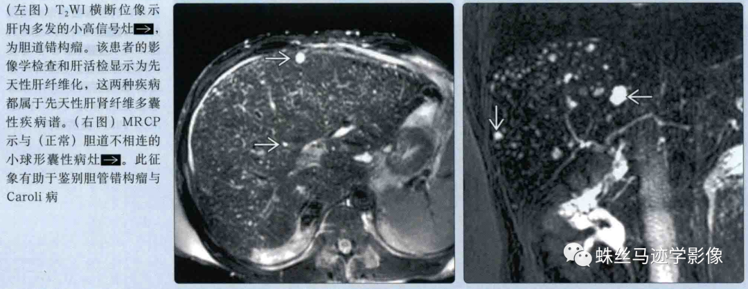 肝内胆管错构瘤和先天性肝内胆管囊状扩张症（Caroli病）-6