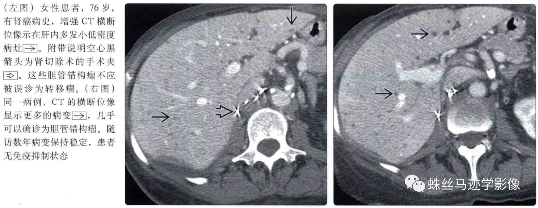 肝内胆管错构瘤和先天性肝内胆管囊状扩张症（Caroli病）-7