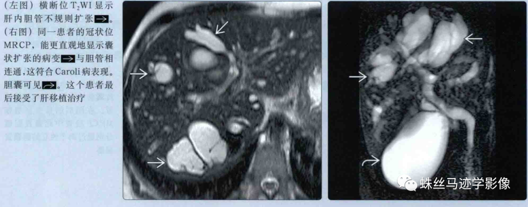肝内胆管错构瘤和先天性肝内胆管囊状扩张症（Caroli病）-13