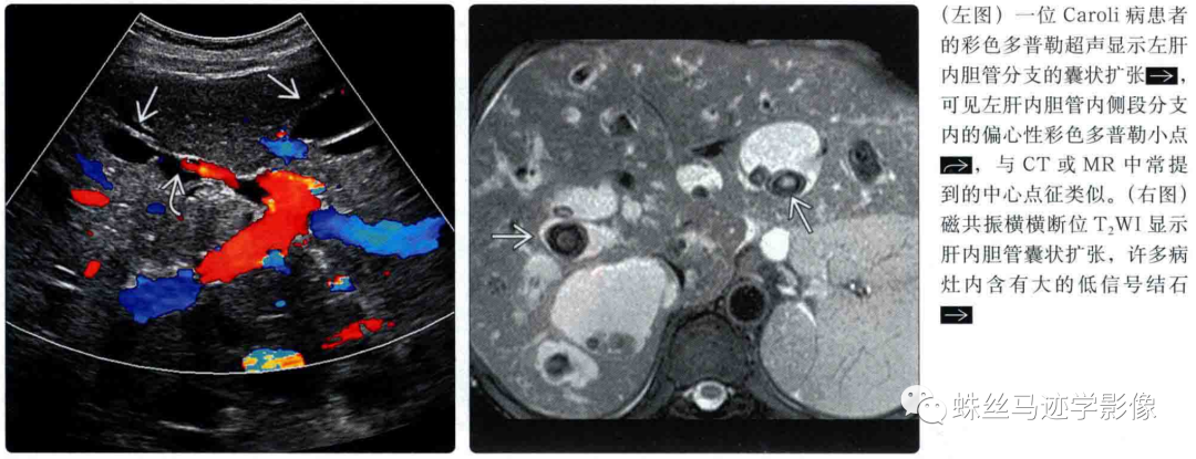 肝内胆管错构瘤和先天性肝内胆管囊状扩张症（Caroli病）-14