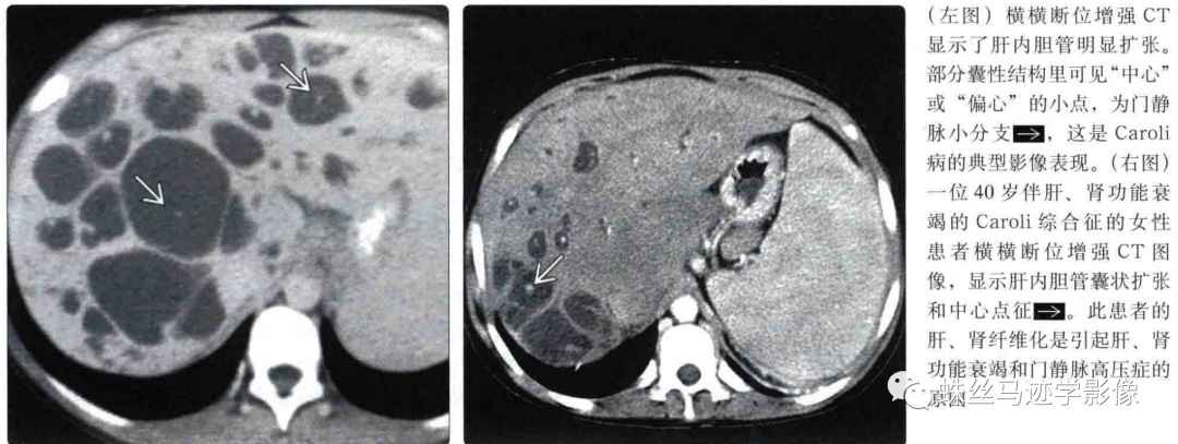 肝内胆管错构瘤和先天性肝内胆管囊状扩张症（Caroli病）-15