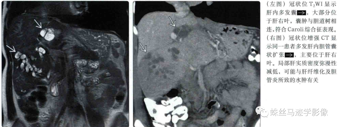 肝内胆管错构瘤和先天性肝内胆管囊状扩张症（Caroli病）-16