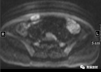 【病例】韧带样纤维瘤1例MR影像-2