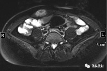 【病例】韧带样纤维瘤1例MR影像-1