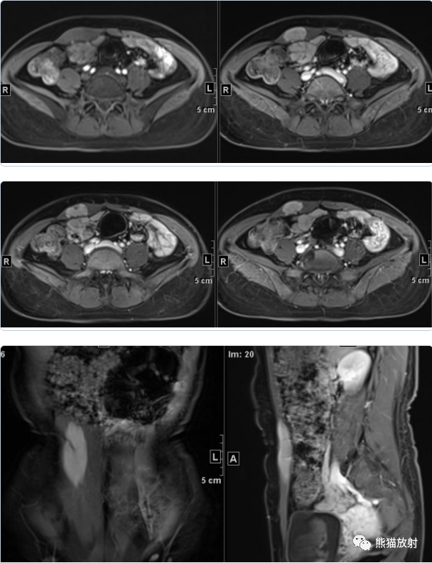 【病例】韧带样纤维瘤1例MR影像-3