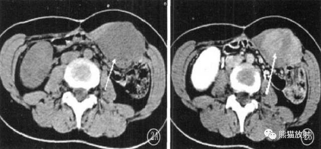【病例】韧带样纤维瘤1例MR影像-9