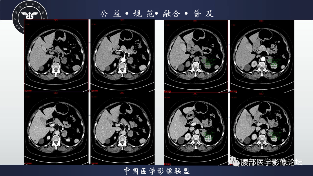 【病例】肾脏透明细胞癌1例CT影像-4