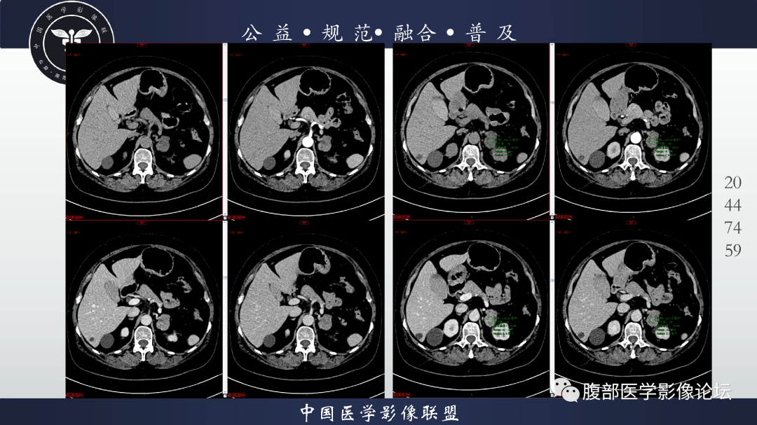 【病例】肾脏透明细胞癌1例CT影像-5